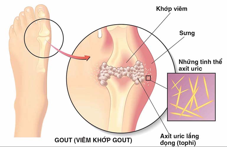 Bệnh gout là bệnh mãn tính xảy ra do tình trạng rối loạn chuyển hóa nhân purin trong thận khiến quá trình lọc axit uric suy yếu