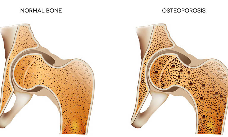 Trong nhiều trường hợp lưng bị đau có thể liên quan tới tình trạng loãng xương