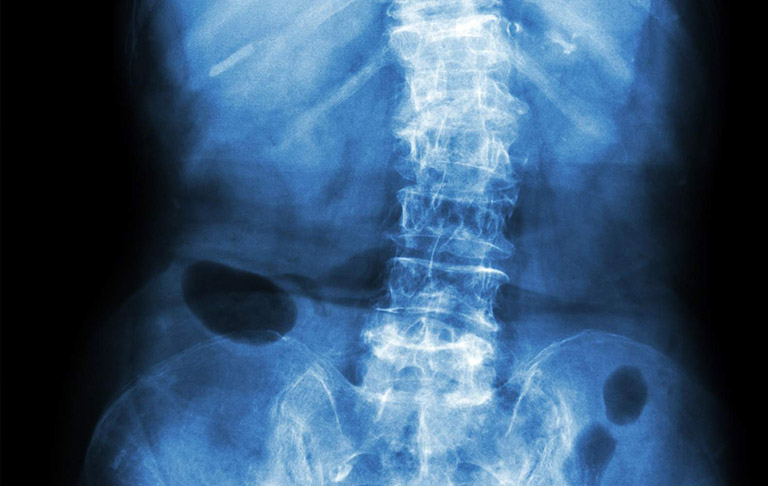 Bác sĩ có thể yêu cầu chụp X-quang để xác định nguyên nhân khiến lưng bị đau