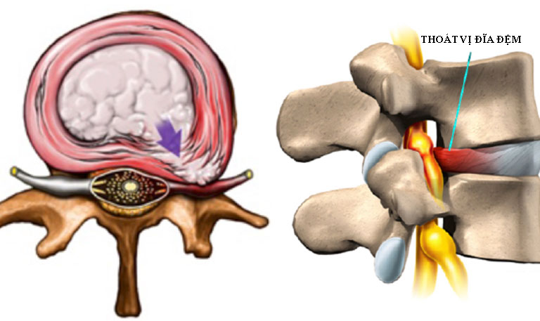 Thoát vị đĩa đệm cột sống là nguyên nhân phổ biến dẫn đến đau dây thần kinh tọa