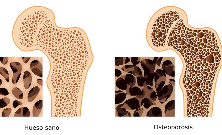 Bệnh loãng xương đặc trưng bởi mật độ và chất lượng xương suy giảm
