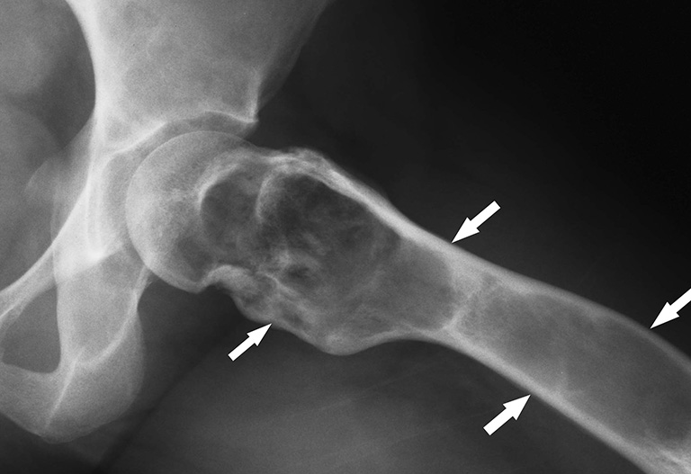 Nang xương phình mạch (Aneurysmal bone cyst)