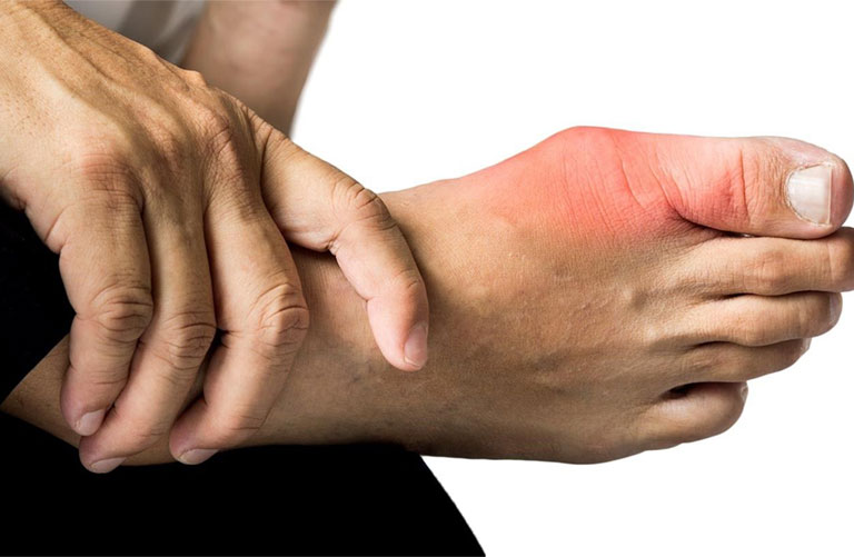 Bệnh Gout thường gây ảnh hưởng đến khớp ngón chân cái