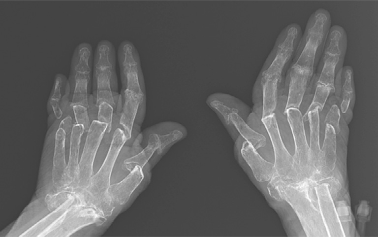 Chụp X - quang có thể giúp bác sĩ xác định các rối loạn bên trong khớp