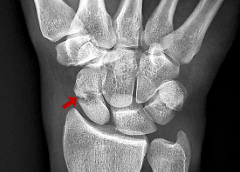 Gãy xương vảy là một tình trạng thường gặp của gãy bàn tay