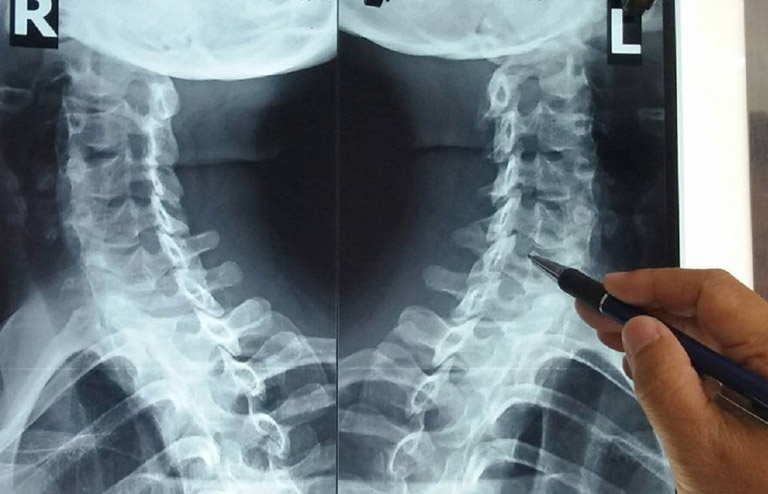 Hình ảnh X-quang giúp chẩn đoán bệnh lý, kiểm tra gai xương, kích thước và sự chèn ép vào các mô hoặc xương khác