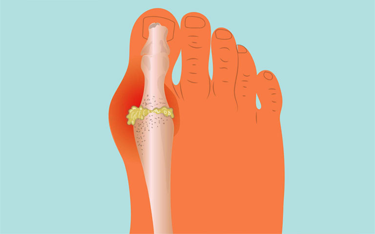 Dấu hiệu bệnh gút ở chân
