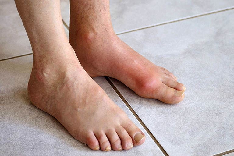 chữa bệnh gout bằng lá lốt có hiệu quả không