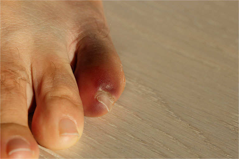 Ngón chân út bị sưng đau 