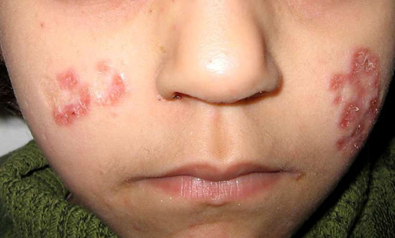 bệnh lupus ban đỏ ở trẻ em