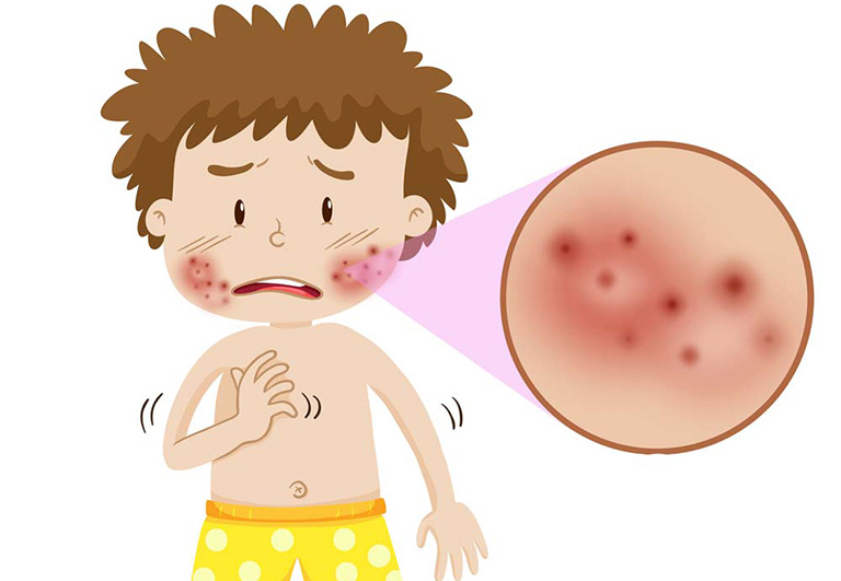 Bệnh lupus ban đỏ ở trẻ em và thông tin cần biết