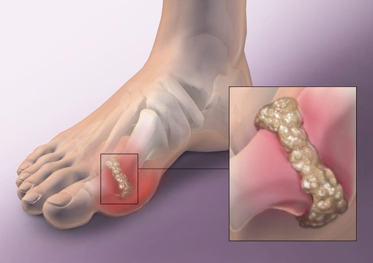 Nguyên nhân gây viêm bao hoạt dịch ngón chân cái
