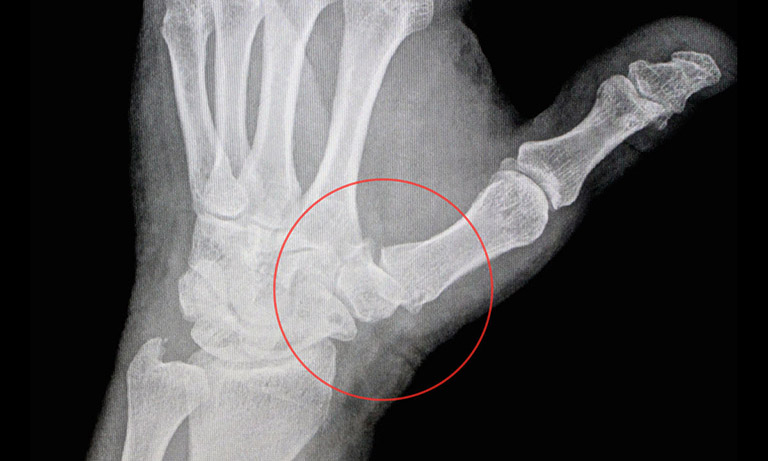 chẩn đoán đau khớp ngón tay cái