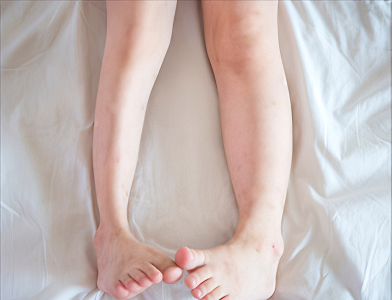 Teo cơ chân có thể xảy ra ở trẻ em do khiếm khuyết hoặc có sai lệch trong bộ gene