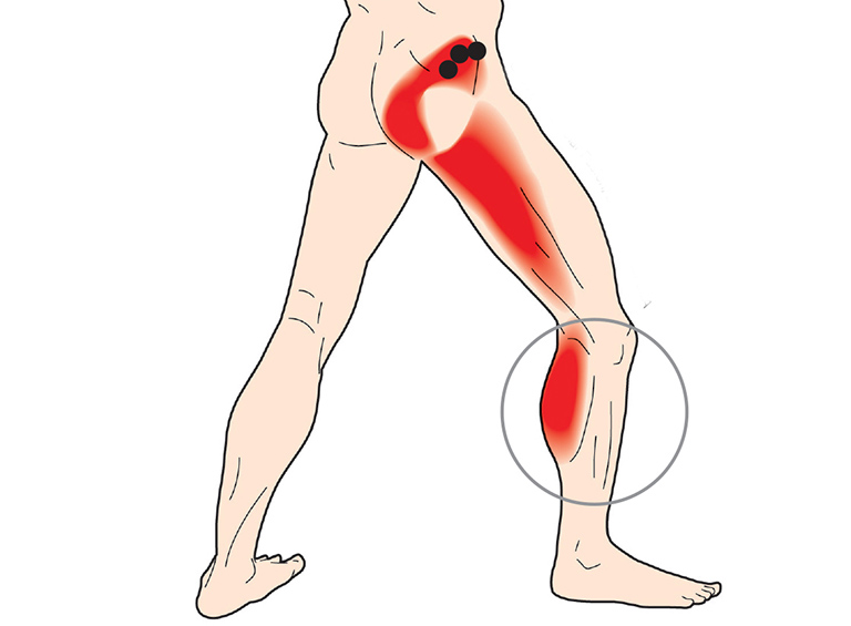 Đau nhức từ mông xuống bắp chân (trái - phải)