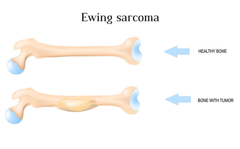 Sarcoma Ewing