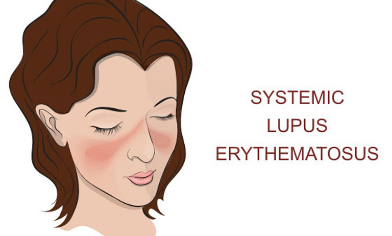 Lupus ban đỏ hệ thống