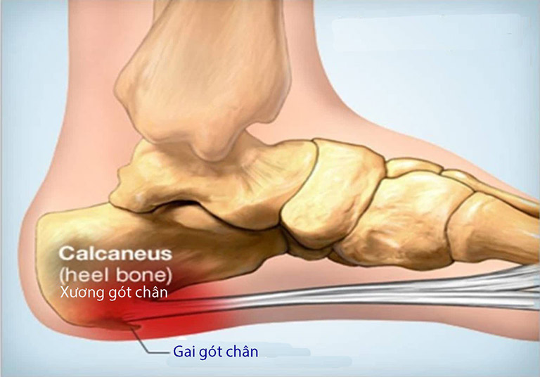 Gai gót chân là tình trạng tích tụ canxi ở vòm bàn chân hoặc ở gót chân