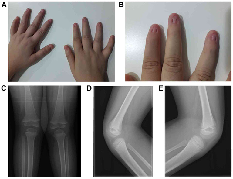 Hội chứng móng và xương bánh chè (nail-patella syndrome)