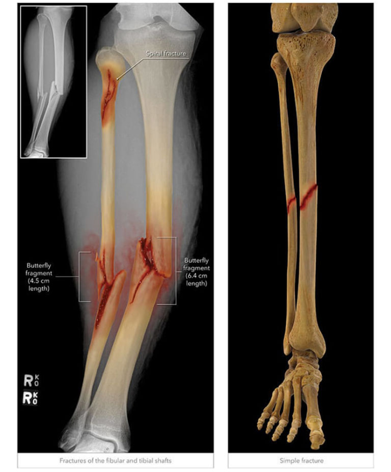 Phân loại gãy xương hở và gãy xương kín ở bệnh nhân bị gãy xương gãy chân