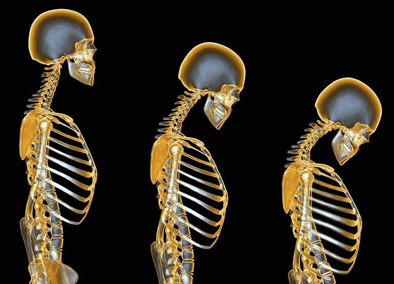 Loãng xương là bệnh lý mãn tính liên quan đến tuổi tác, dễ gây biến chứng và rất khó để kiểm soát
