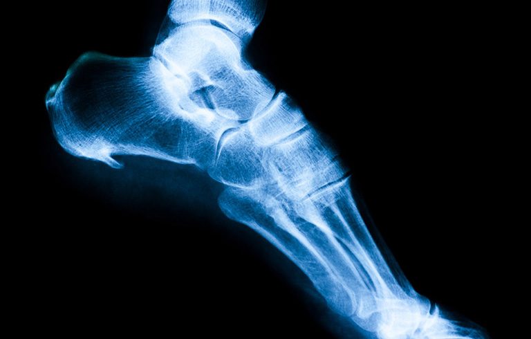 Hình dạng, kích thước của gai xương trên hình ảnh X-quang