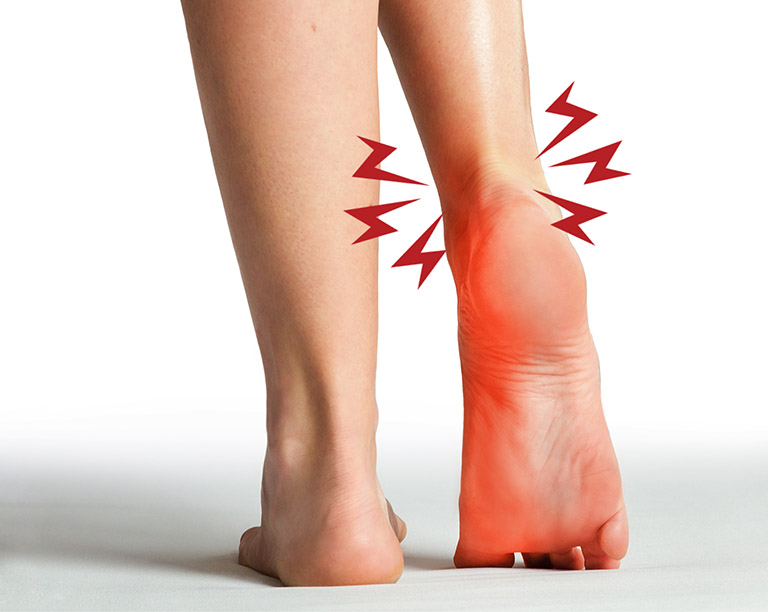 Dấu hiệu nhận biết căng cơ bàn chân