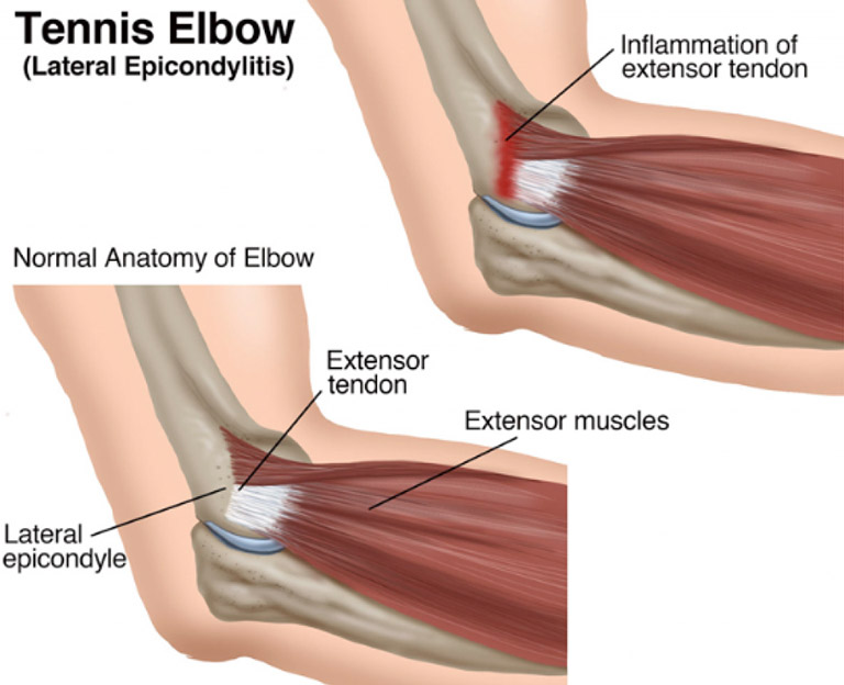 Hội chứng Tennis Elbow