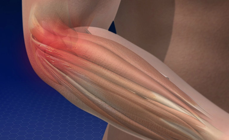 Hội chứng Tennis Elbow không được điều trị dẫn đến mất chức năng vận động và teo cơ