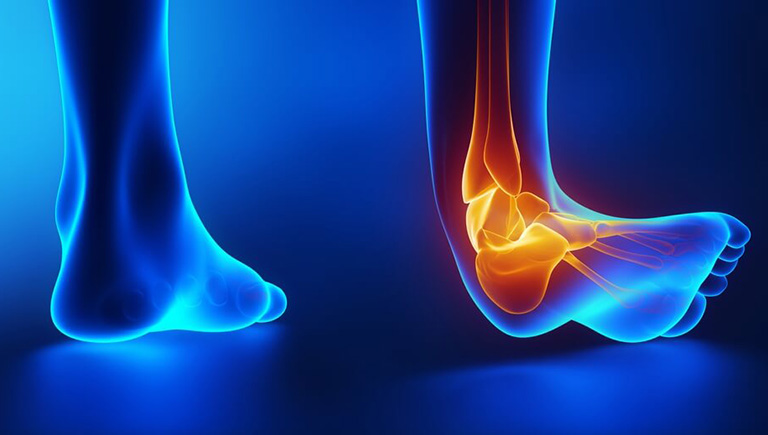 Trật khớp cổ chân là một chấn thương nghiêm trọng, thường mất từ 4 - 12 tháng để chữa lành