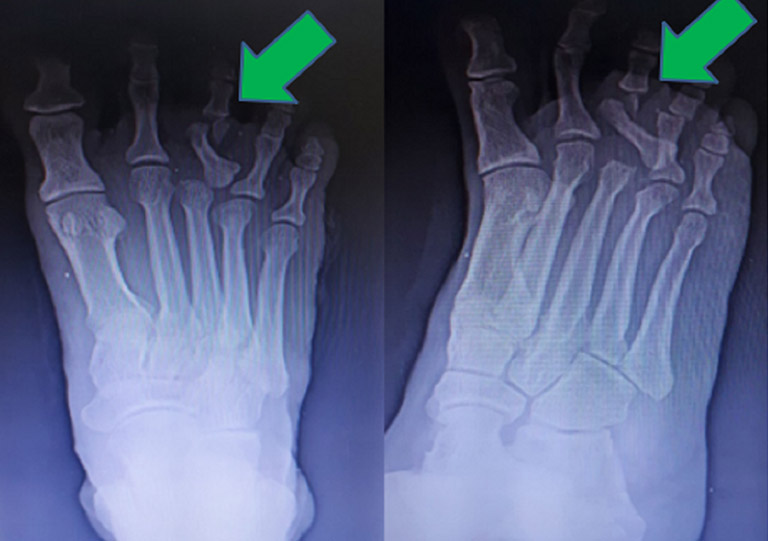 Trật khớp ngón chân xảy ra khi một trong các khớp bị biến dạng, xương ngón chân bị đẩy khỏi vị trí của nó
