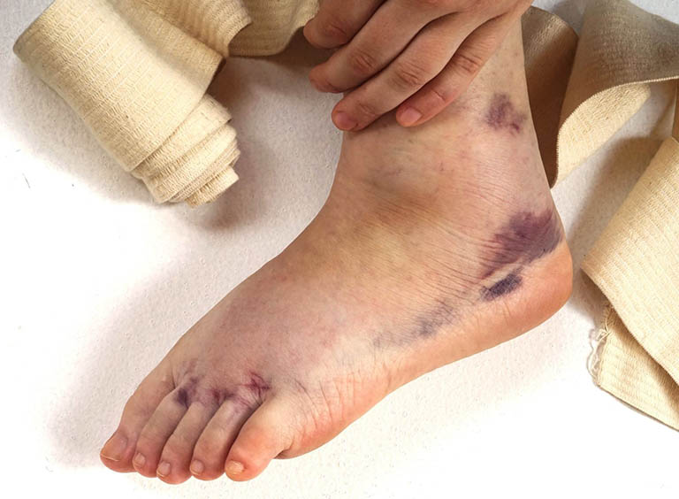 Trẹo chân gây trật khớp khiến cổ chân sưng to, bầm tím và biến dạng