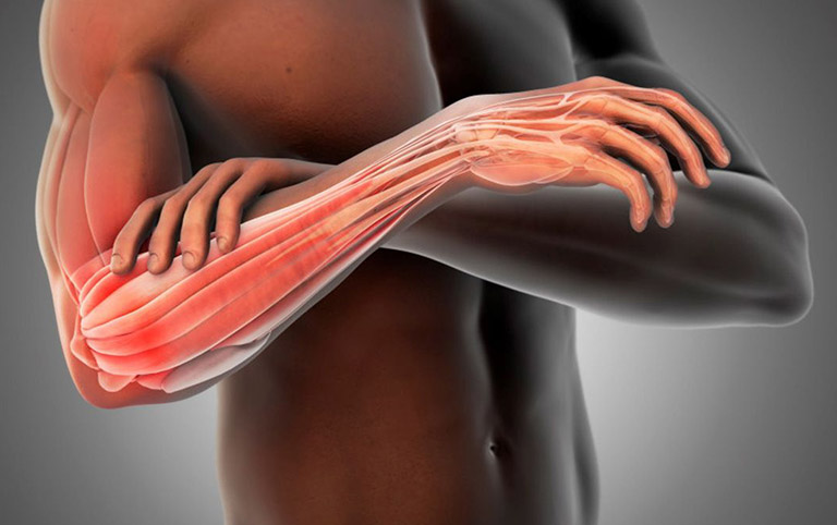 Viêm điểm bám gân khuỷu tay có thể làm tăng nguy cơ đứt gân và thoái hóa