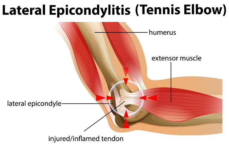 Một số trường hợp không thể xác định nguyên nhân gây hội chứng Tennis elbow