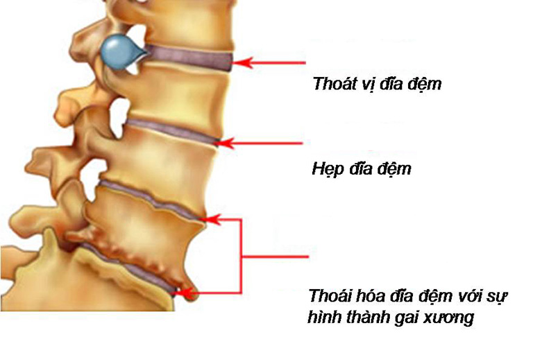 Khó chịu và mỏi lưng là triệu chứng ban đầu của những bệnh lý ở cột sống 