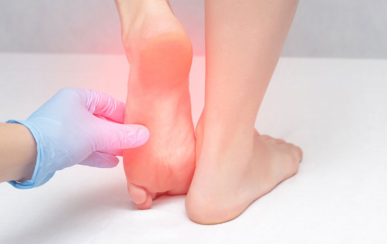 Bệnh gout đau gót chân