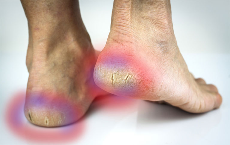 Bệnh gout có gây đau gót chân không