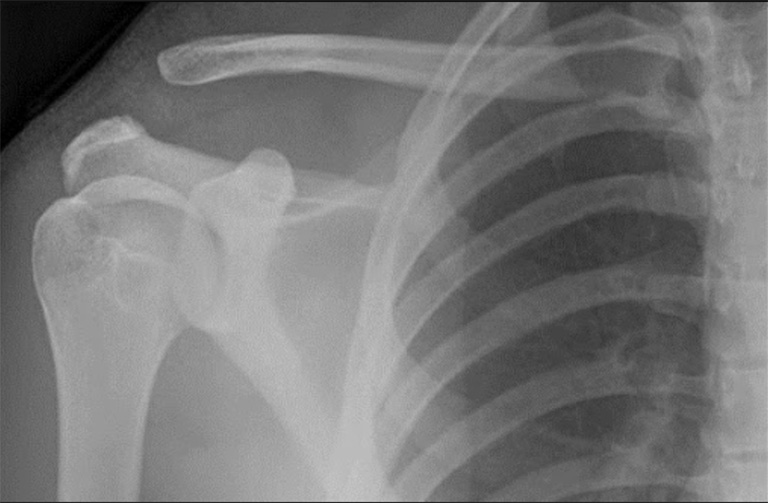 Tình trạng di lệch đầu ngoài xương đòn do trật khớp cùng đòn trên hình ảnh X-quang