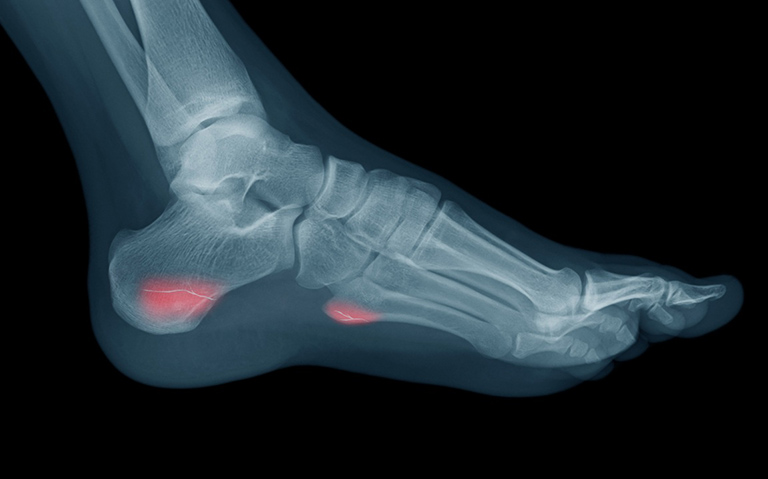 Không áp dụng cách xoa bóp bấm huyệt chữa đau gót chân cho người bị gãy xương 