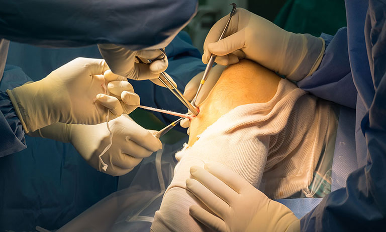 Bệnh nhân bị đứt dây chằng chéo trước rách sụn chêm thường được chỉ định phẫu thuật nội soi khớp