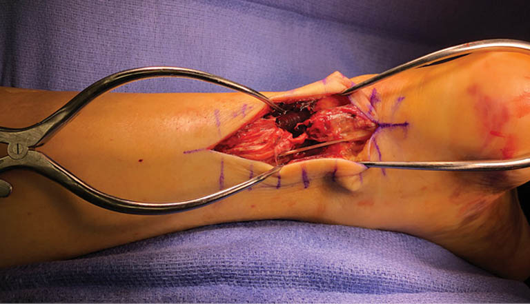 Quy trình phẫu thuật nối gân gót chân