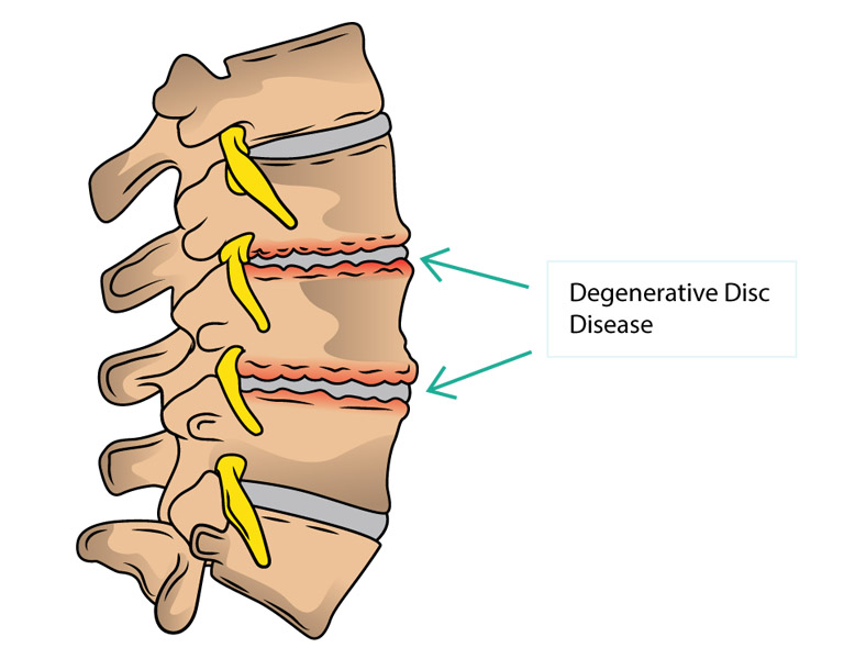Thoái hóa cột sống thắt lưng gây đau lưng khi bê vật nặng