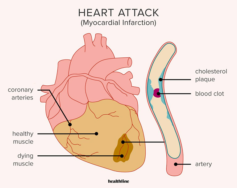 Nhồi máu cơ tim (đau tim)