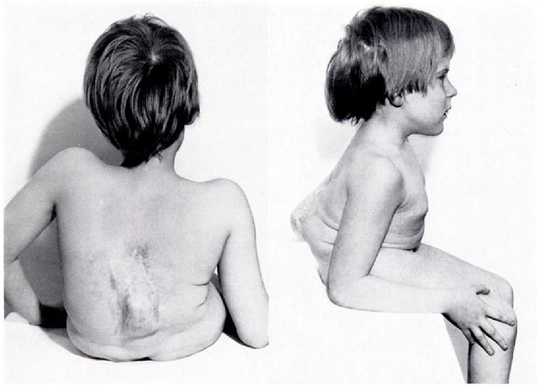 Dị tật bẩm sinh gây lồi đốt sống lưng ở trẻ