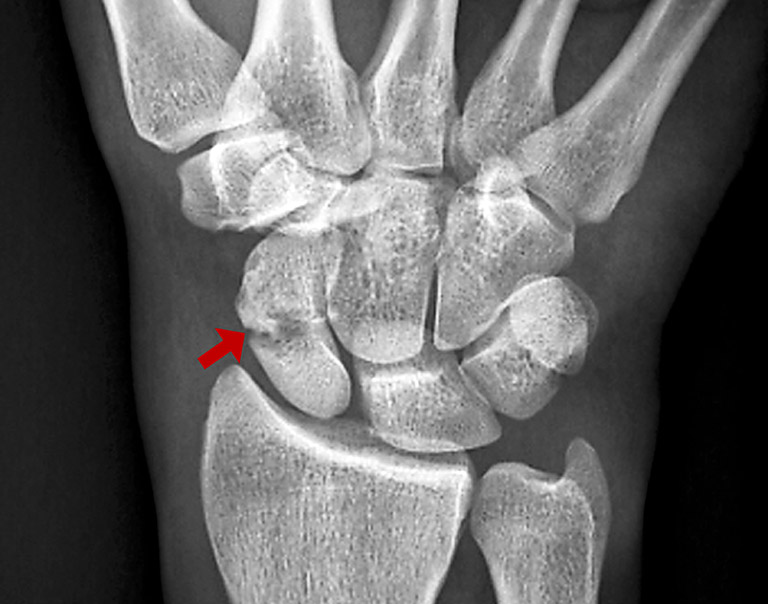 Chụp X-quang chẩn đoán gãy xương cổ tay