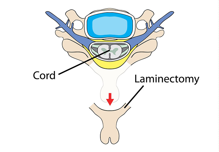 Cắt bỏ laminectomy