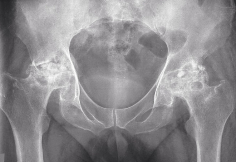 Chụp X-quang chẩn đoán hoại tử xương