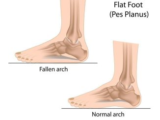 hội chứng bàn chân phẳng