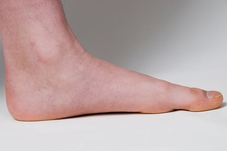 Chấn thương có thể làm phát triển hội chứng bàn chân phẳng ở người lớn