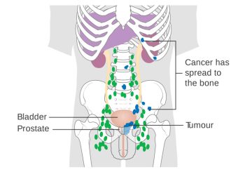 ung thư tuyến tiền liệt di căn xương